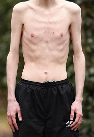 progeria